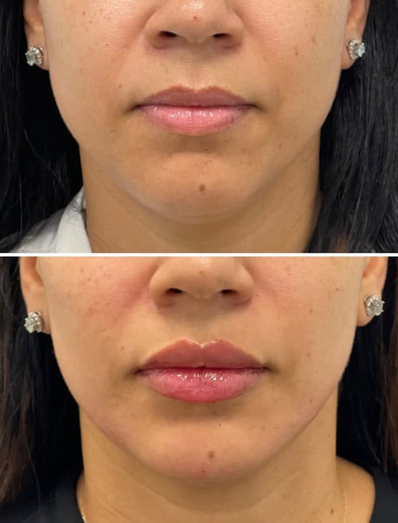 Lip Injections Before & After Gallery - Patient 428349 - Image 1