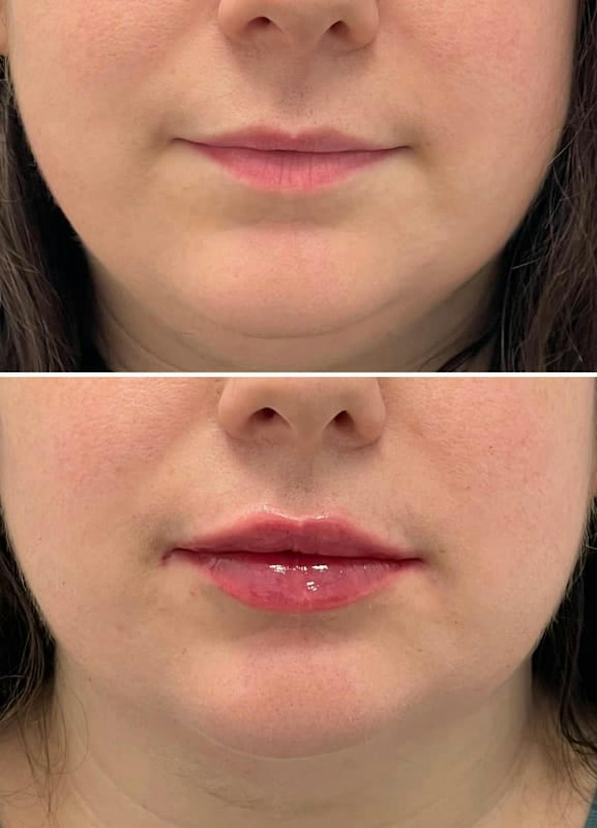 Lip Injections Before & After Gallery - Patient 346211 - Image 1
