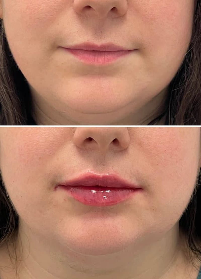 Lip Injections Before & After Gallery - Patient 346211 - Image 1