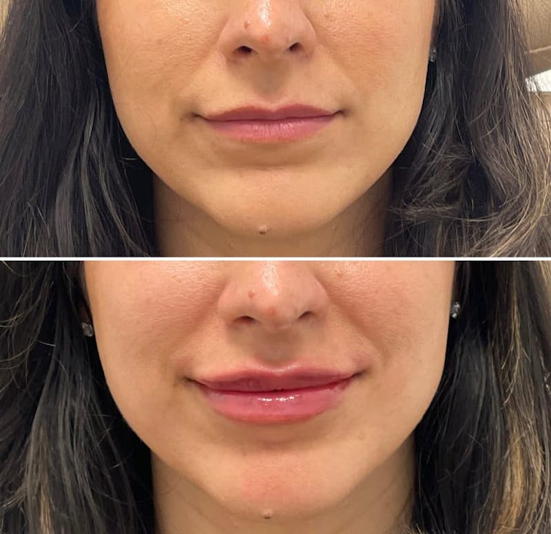 Lip Injections Before & After Gallery - Patient 144324 - Image 1