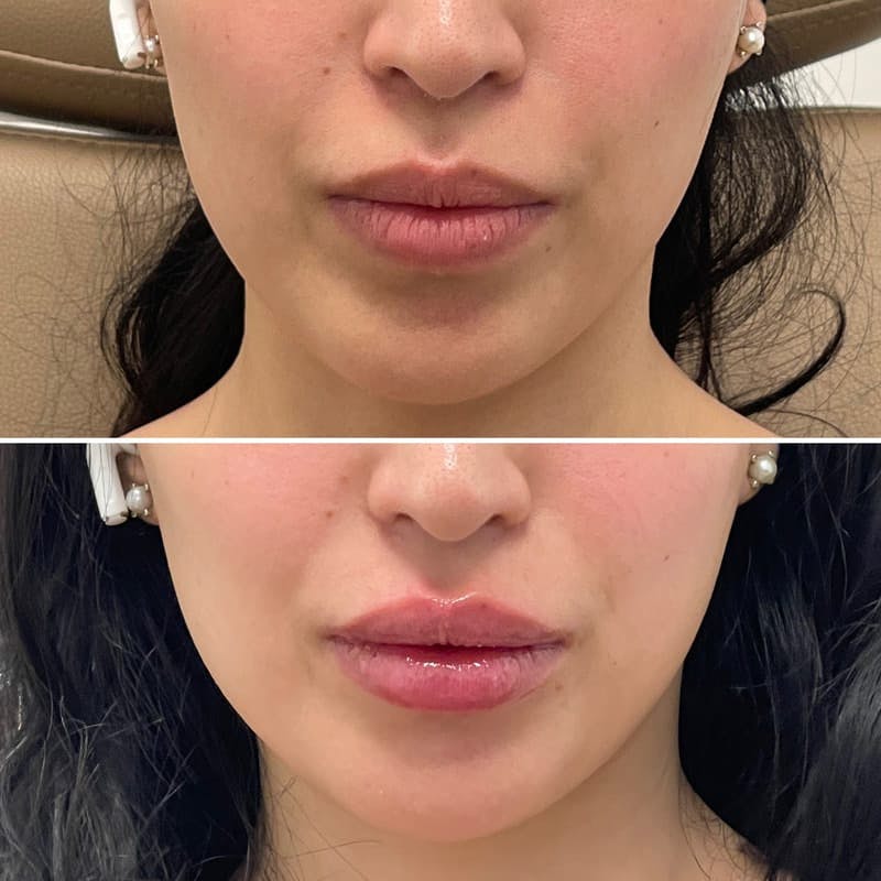 Lip Injections Before & After Gallery - Patient 330368 - Image 1