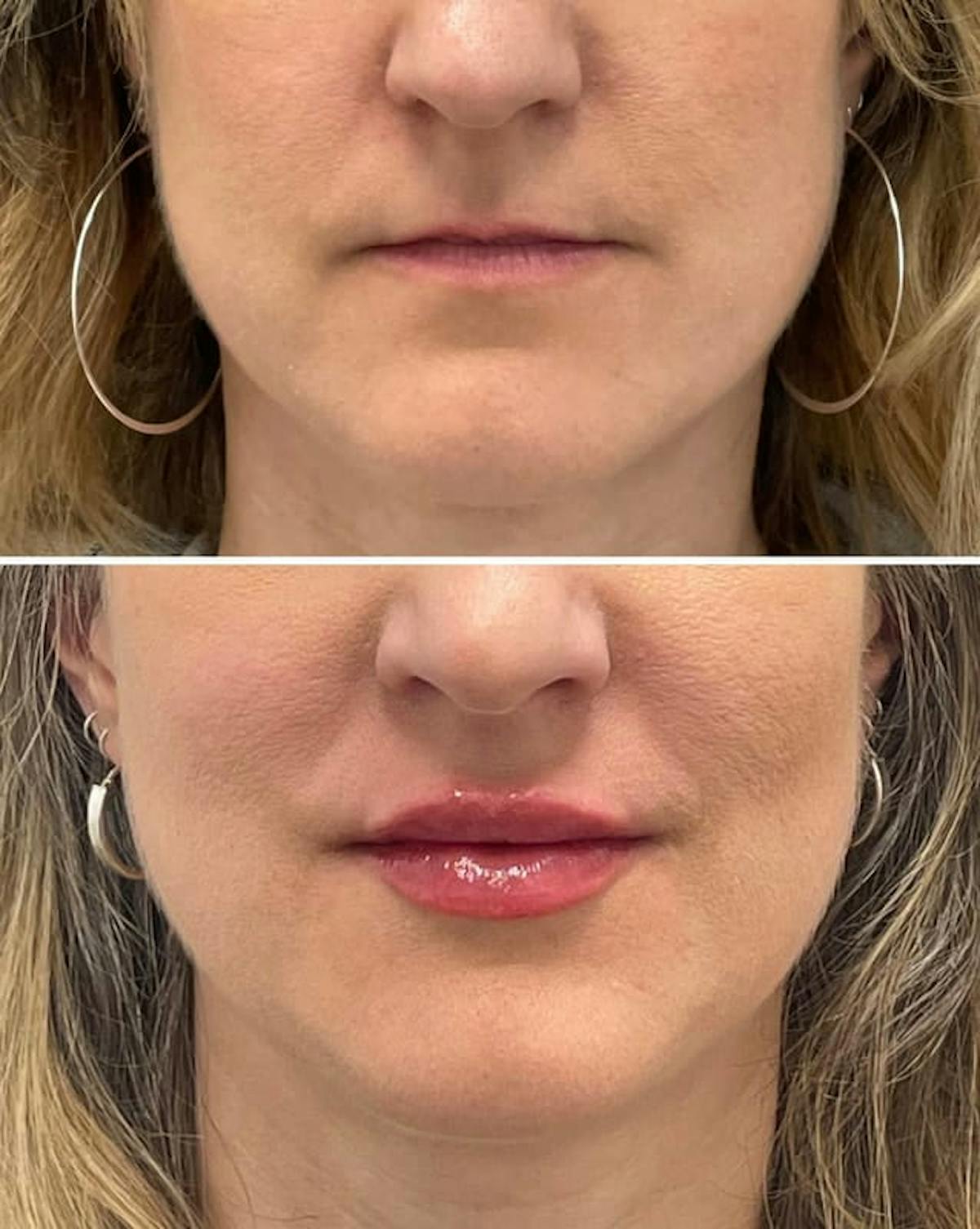 Lip Injections Before & After Gallery - Patient 379131 - Image 1