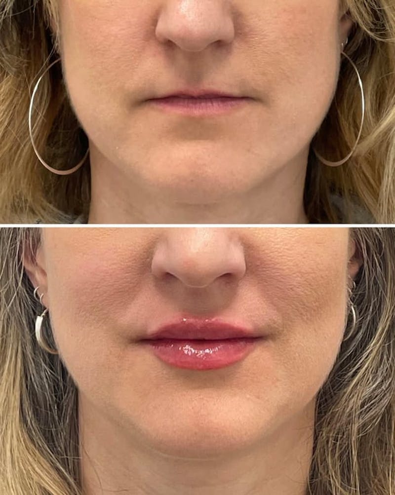 Lip Injections Before & After Gallery - Patient 379131 - Image 1