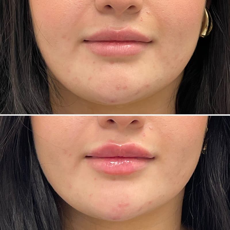Lip Injections Before & After Gallery - Patient 353282 - Image 1