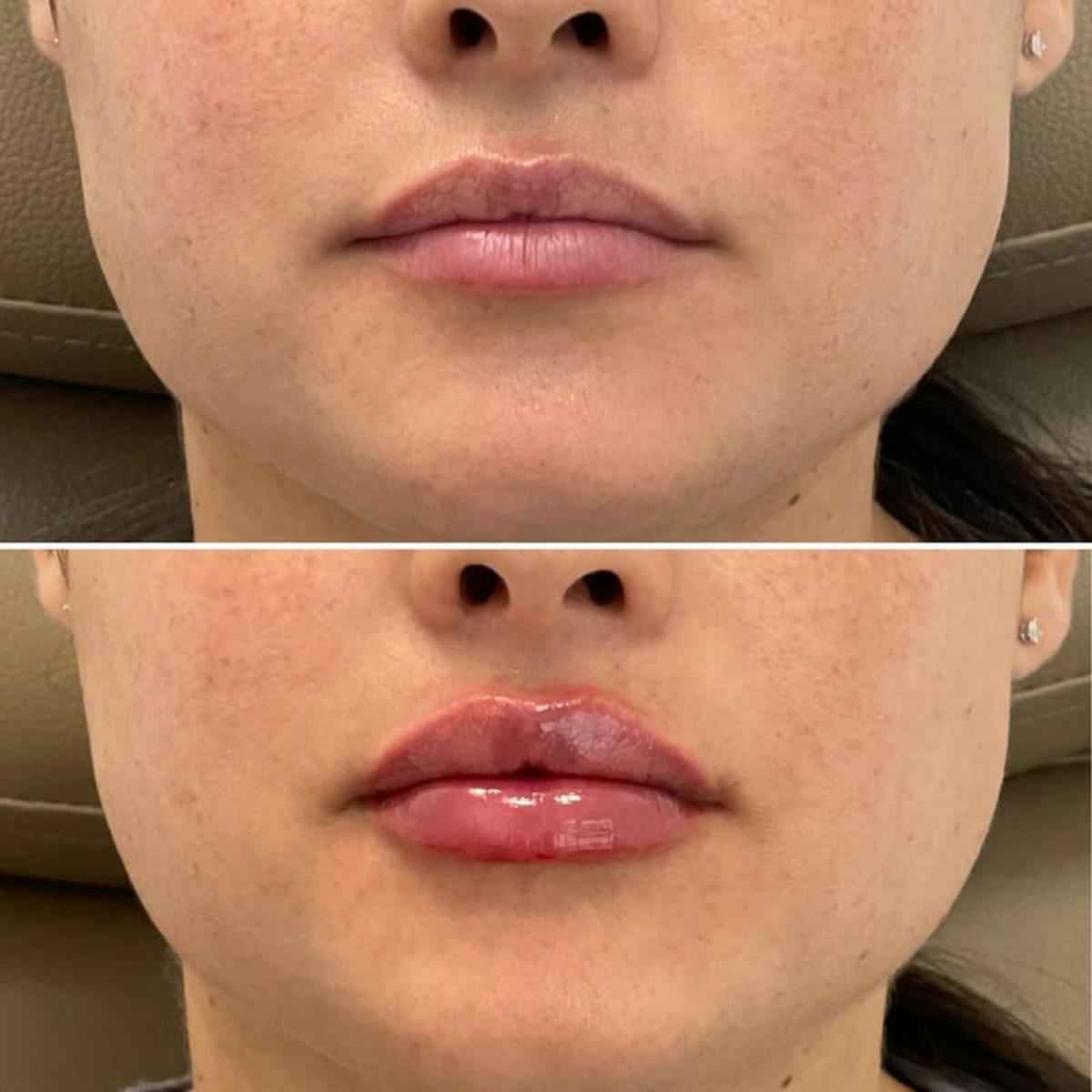 Lip Injections Before & After Gallery - Patient 143215 - Image 1