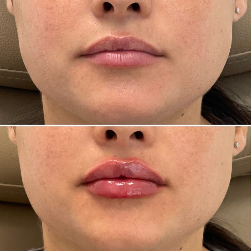 Lip Injections Before & After Gallery - Patient 143215 - Image 1
