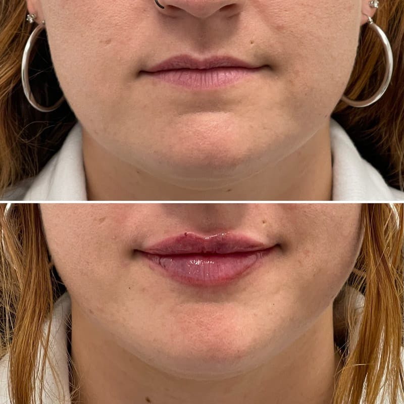 Lip Injections Before & After Gallery - Patient 538050 - Image 1