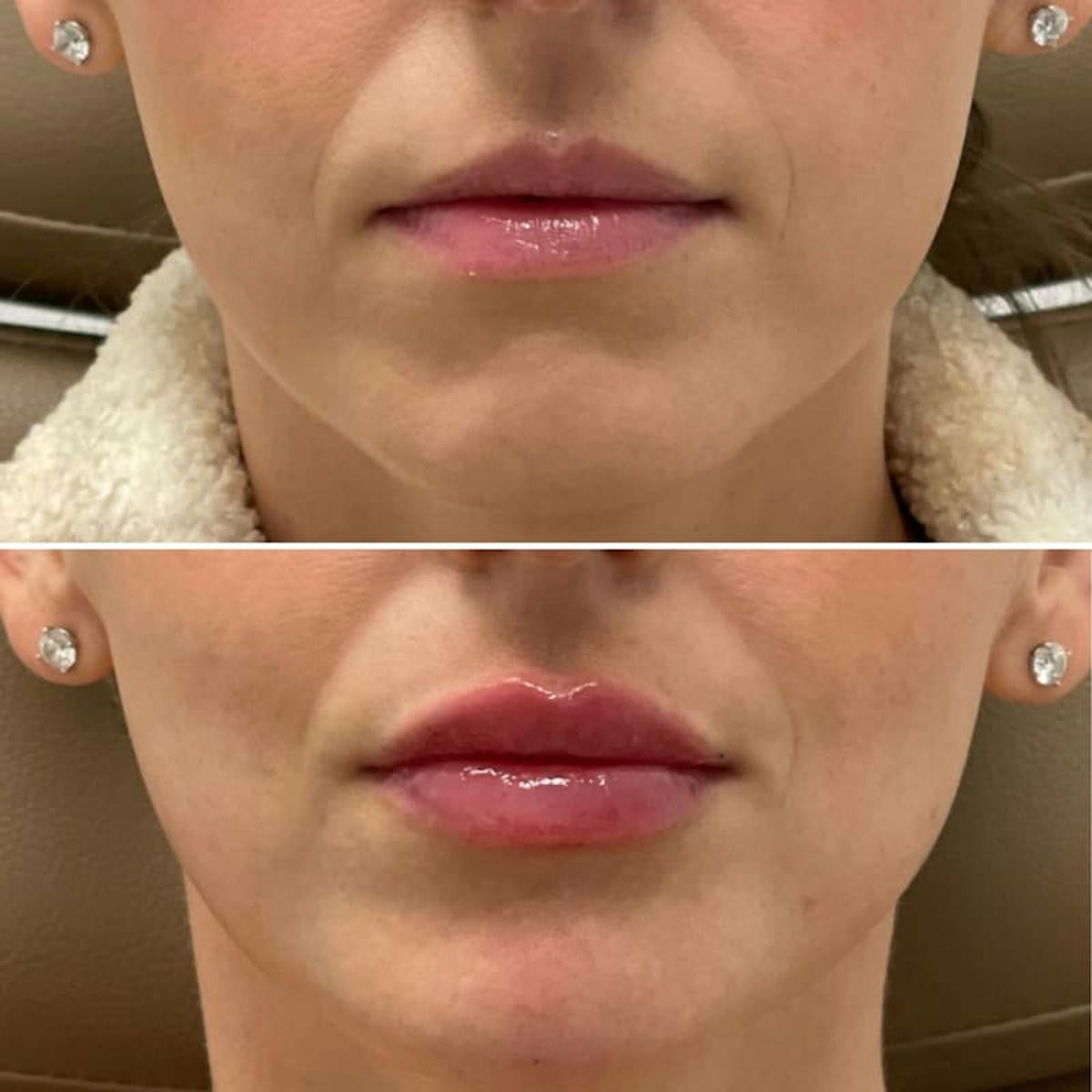 Lip Injections Before & After Gallery - Patient 351750 - Image 1