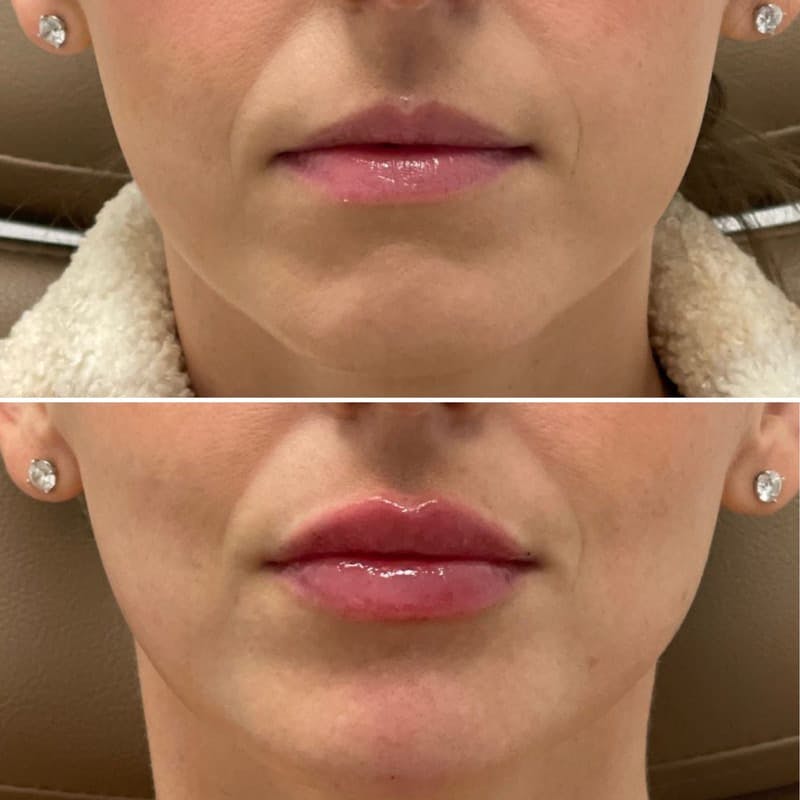 Lip Injections Before & After Gallery - Patient 351750 - Image 1