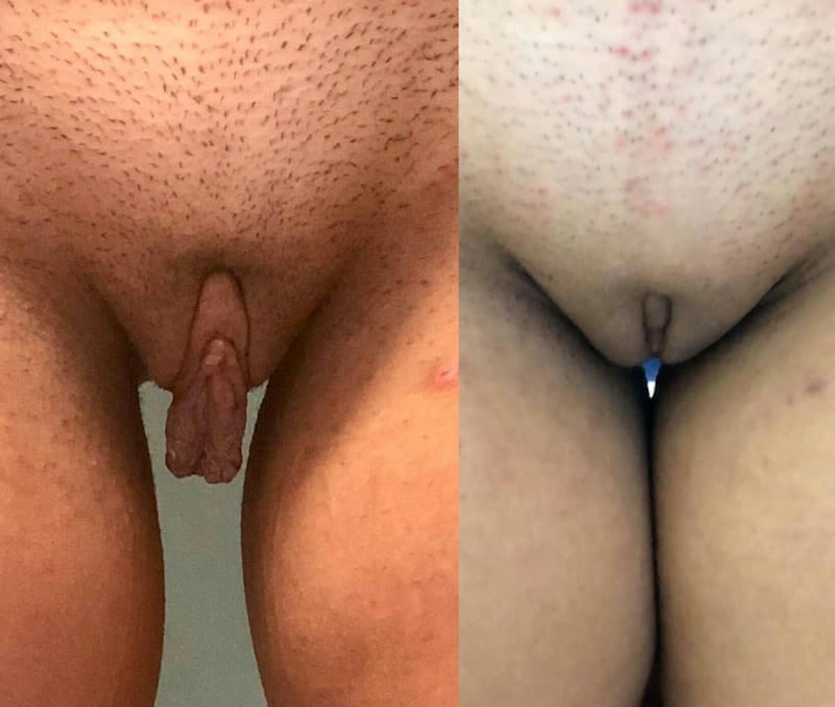 Labiaplasty Before & After Gallery - Patient 898343 - Image 1