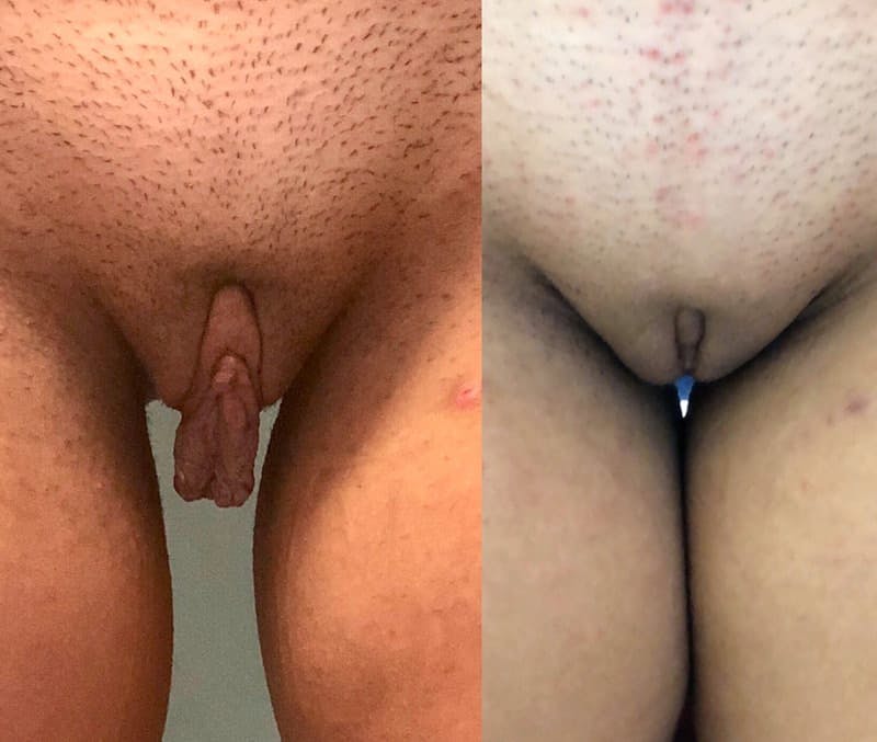 Labiaplasty Before & After Gallery - Patient 898343 - Image 1