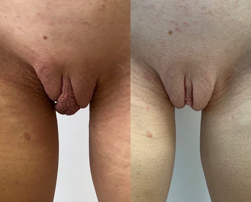 Labiaplasty Before & After Gallery - Patient 211334 - Image 1