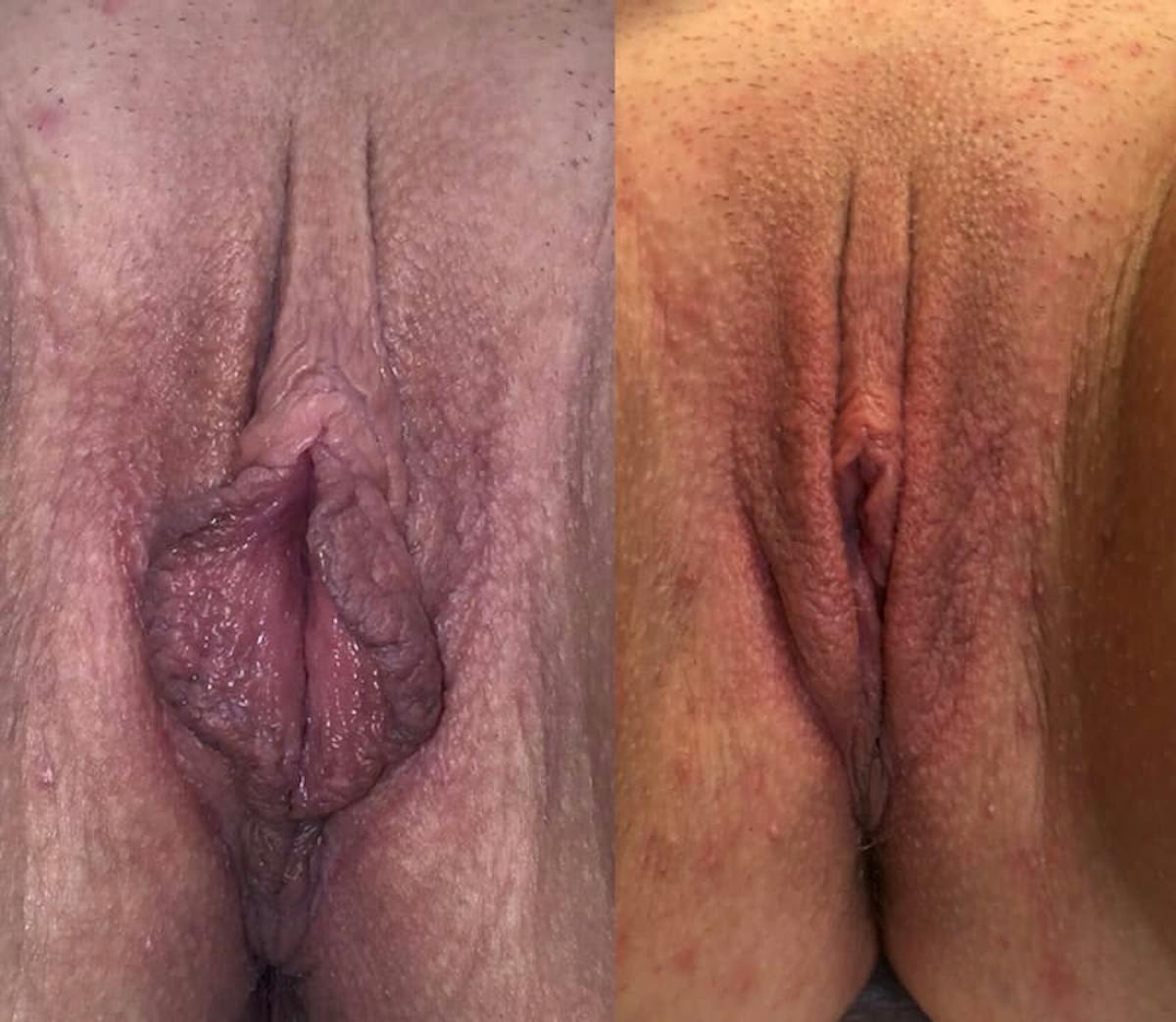 Labiaplasty Before & After Gallery - Patient 175080 - Image 1
