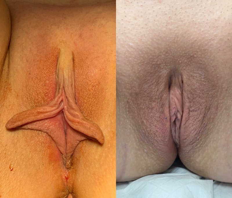 Labiaplasty Before & After Gallery - Patient 161233 - Image 1