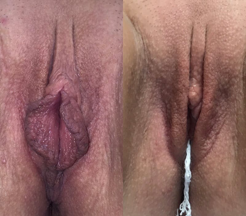 Labiaplasty Before & After Gallery - Patient 201488 - Image 1