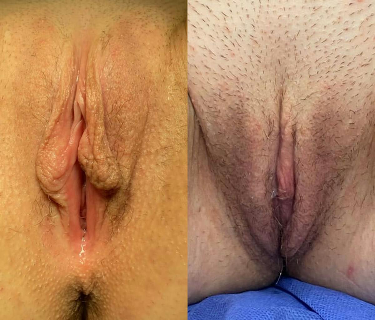 Labiaplasty Before & After Gallery - Patient 238101 - Image 1