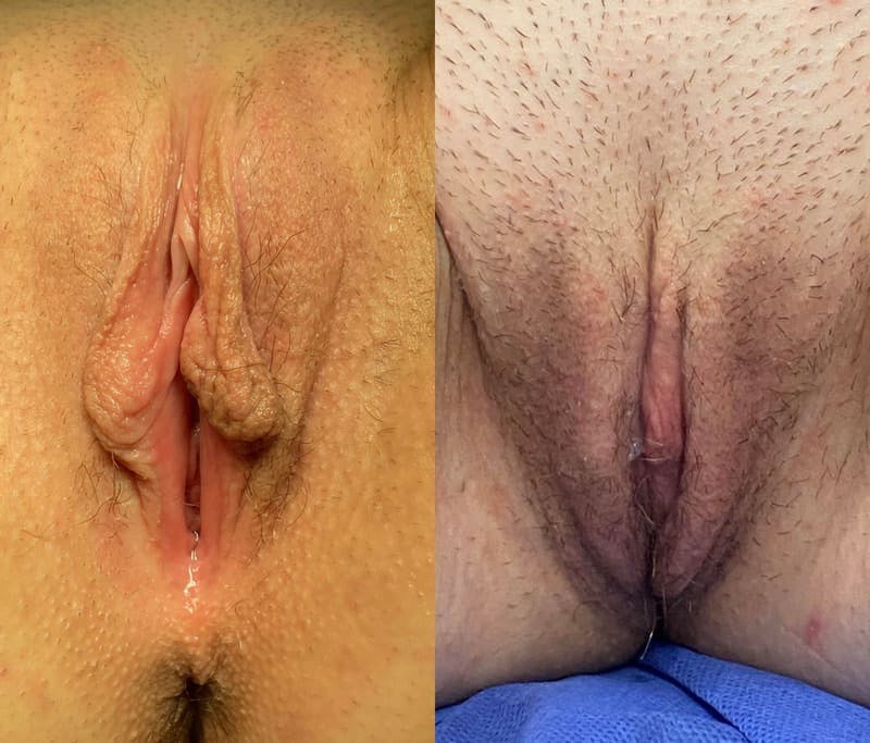 Labiaplasty Before & After Gallery - Patient 238101 - Image 1
