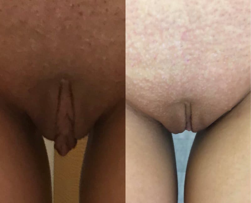 Labiaplasty Before & After Gallery - Patient 412620 - Image 1