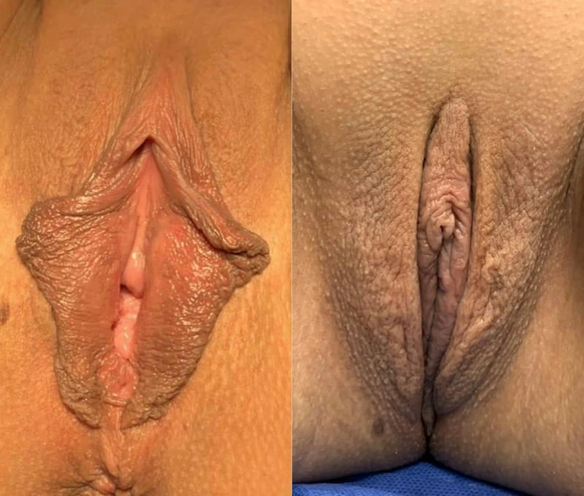 Labiaplasty Before & After Gallery - Patient 406051 - Image 1
