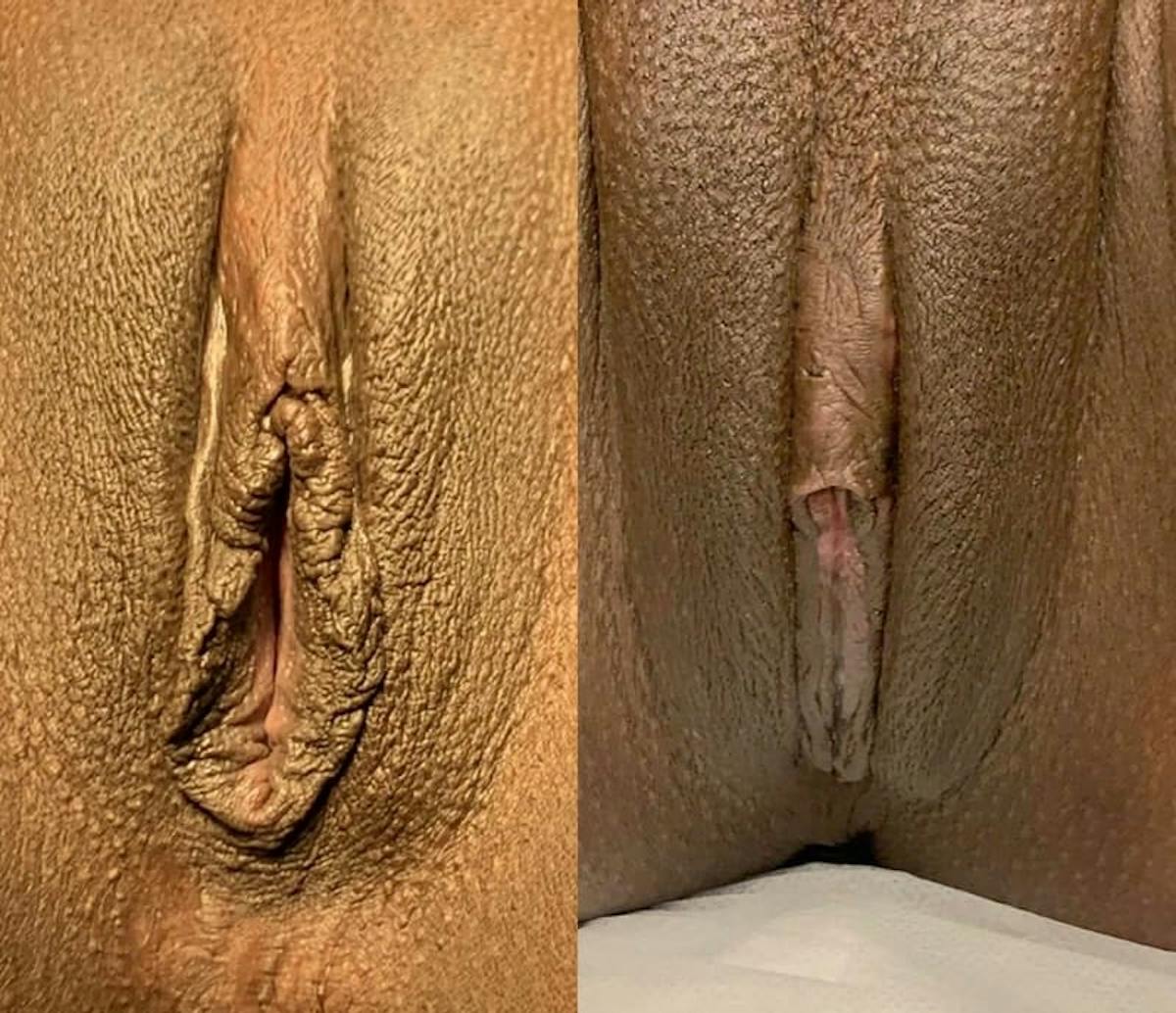Labiaplasty Before & After Gallery - Patient 300491 - Image 1