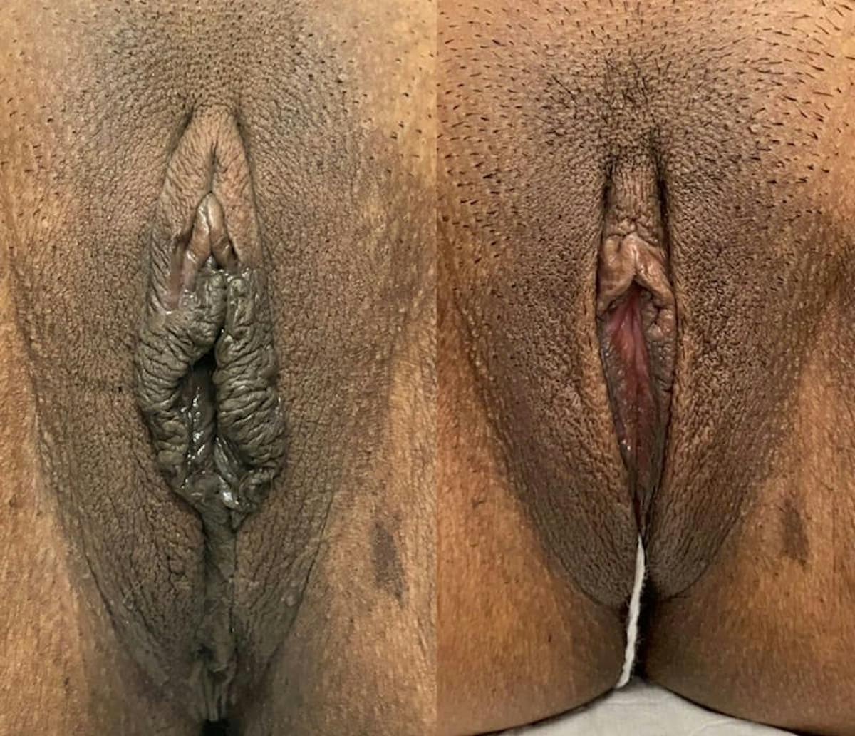 Labiaplasty Before & After Gallery - Patient 596797 - Image 1