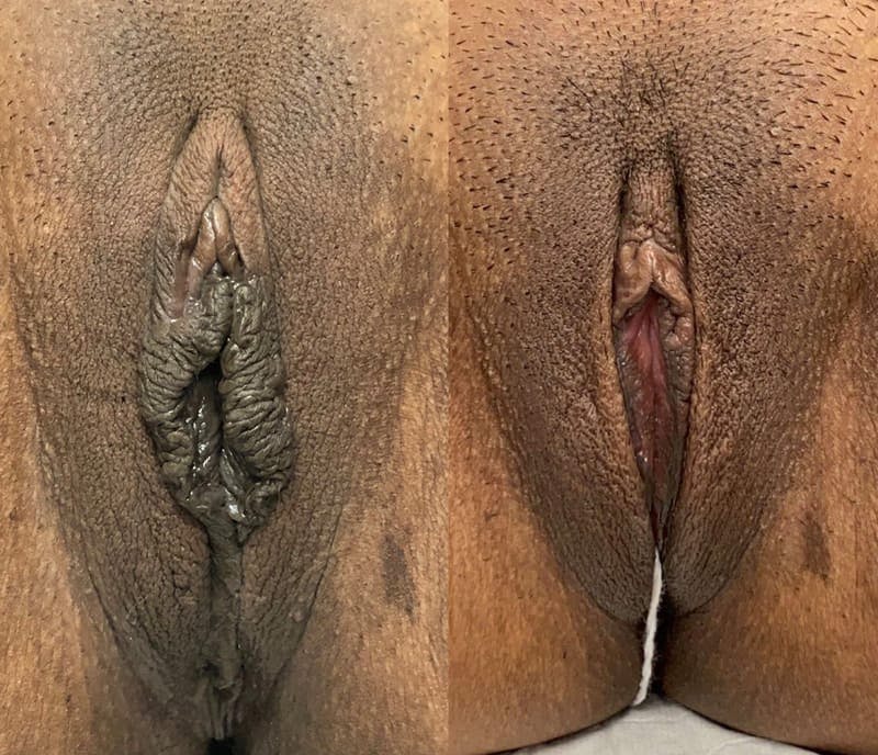 Labiaplasty Before & After Gallery - Patient 596797 - Image 1