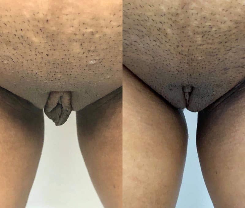Labiaplasty Before & After Gallery - Patient 352454 - Image 1