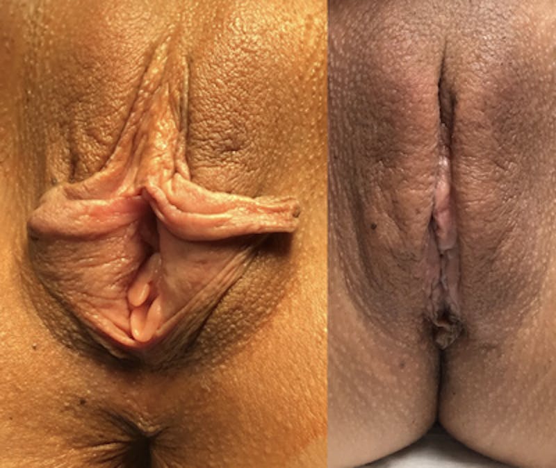 Labiaplasty Before & After Gallery - Patient 131306 - Image 1