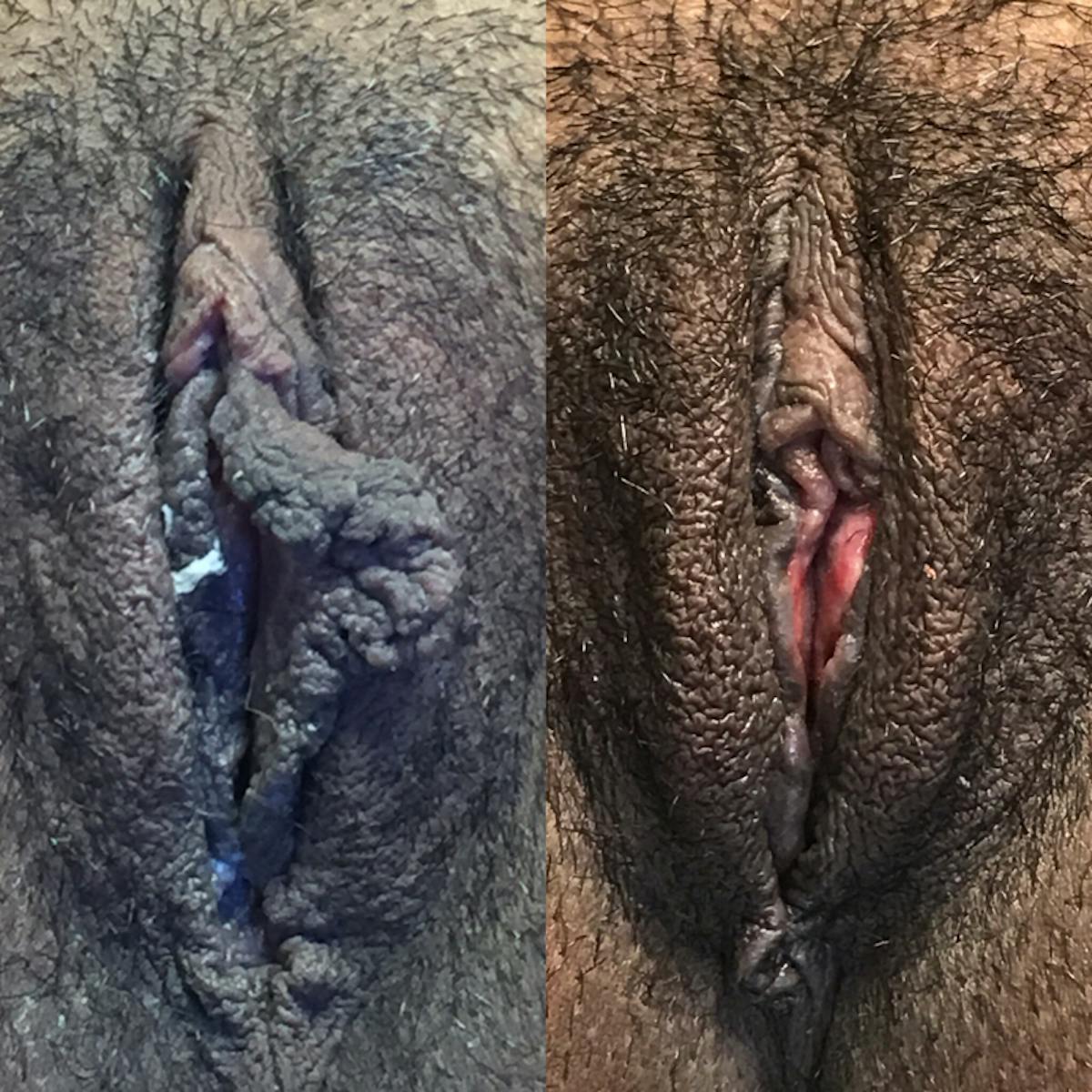 Labiaplasty Before & After Gallery - Patient 103156 - Image 1