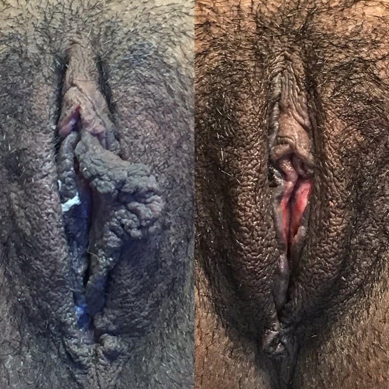 Labiaplasty Before & After Gallery - Patient 103156 - Image 1