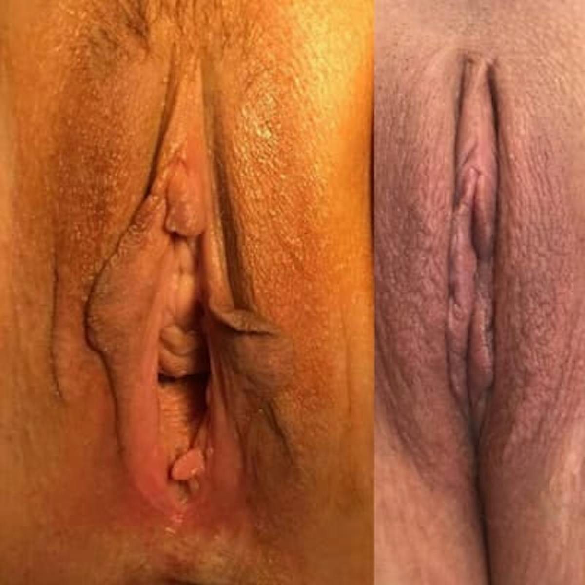 Labiaplasty Before & After Gallery - Patient 158080 - Image 1