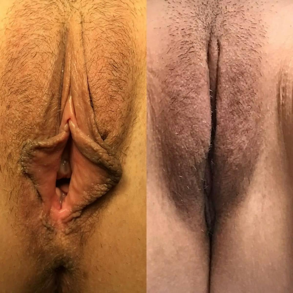 Labiaplasty Before & After Gallery - Patient 304369 - Image 1