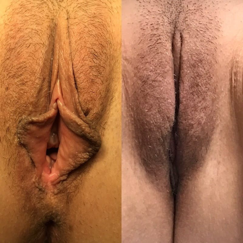 Labiaplasty Before & After Gallery - Patient 304369 - Image 1