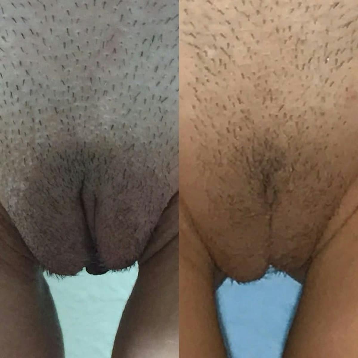 Labiaplasty Before & After Gallery - Patient 399713 - Image 1