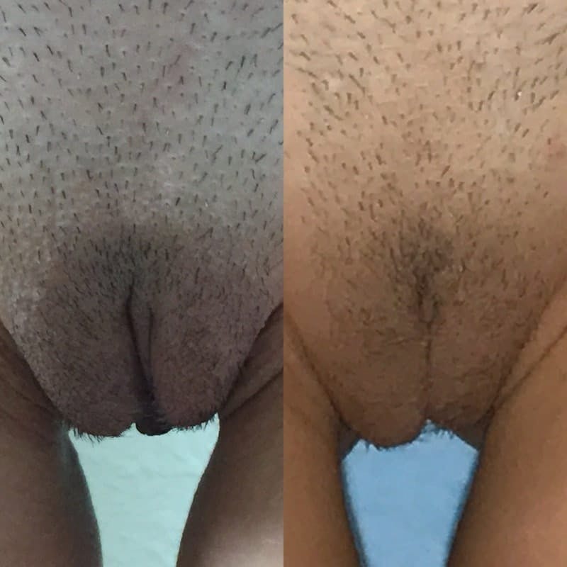 Labiaplasty Before & After Gallery - Patient 399713 - Image 1
