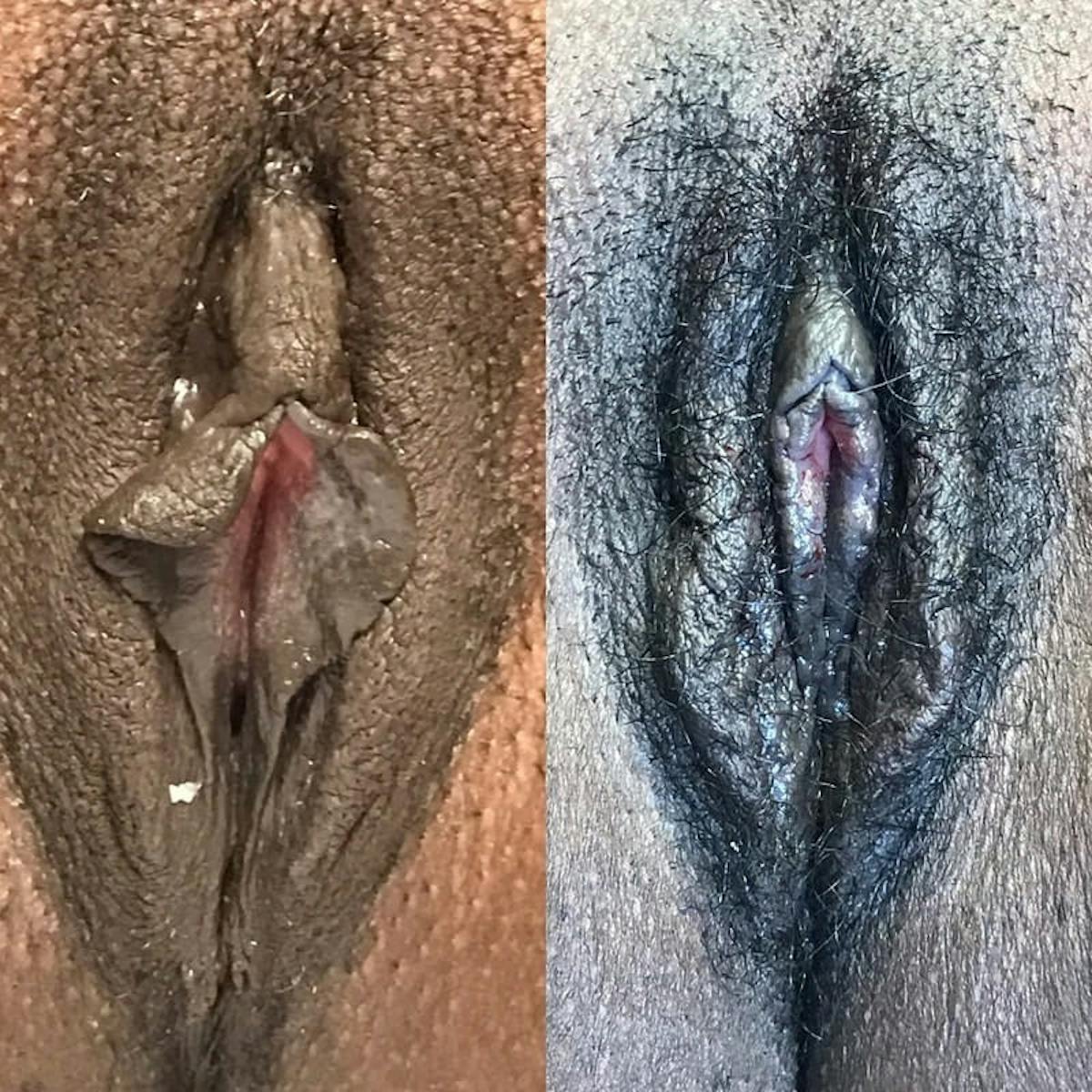 Labiaplasty Before & After Gallery - Patient 231556 - Image 1
