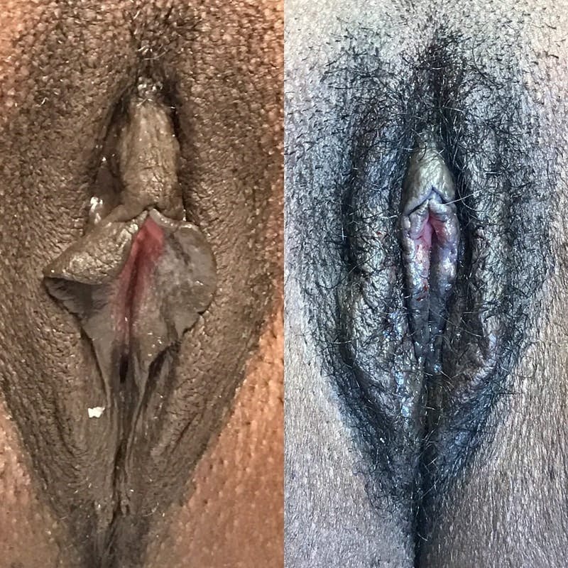 Labiaplasty Before & After Gallery - Patient 231556 - Image 1