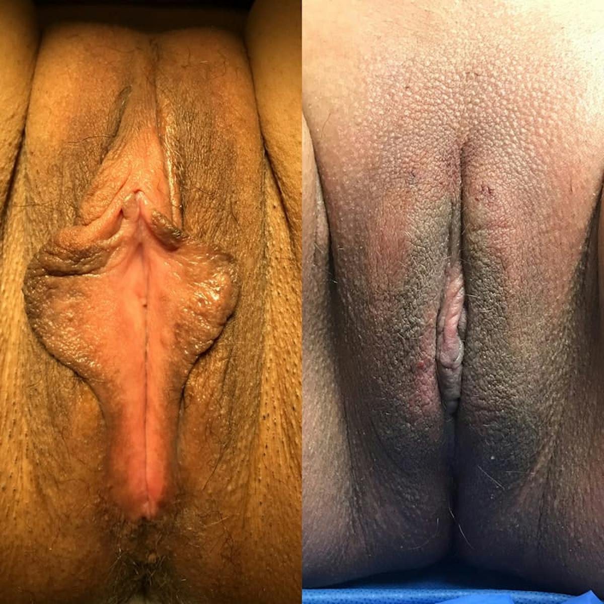 Labiaplasty Before & After Gallery - Patient 274111 - Image 1
