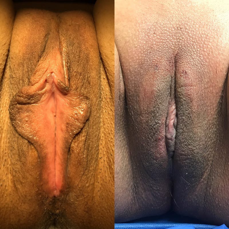 Labiaplasty Before & After Gallery - Patient 274111 - Image 1