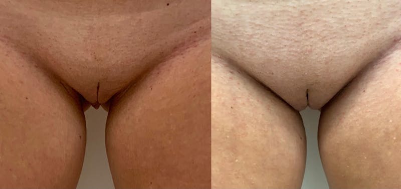 Labiaplasty Before & After Gallery - Patient 160792 - Image 1
