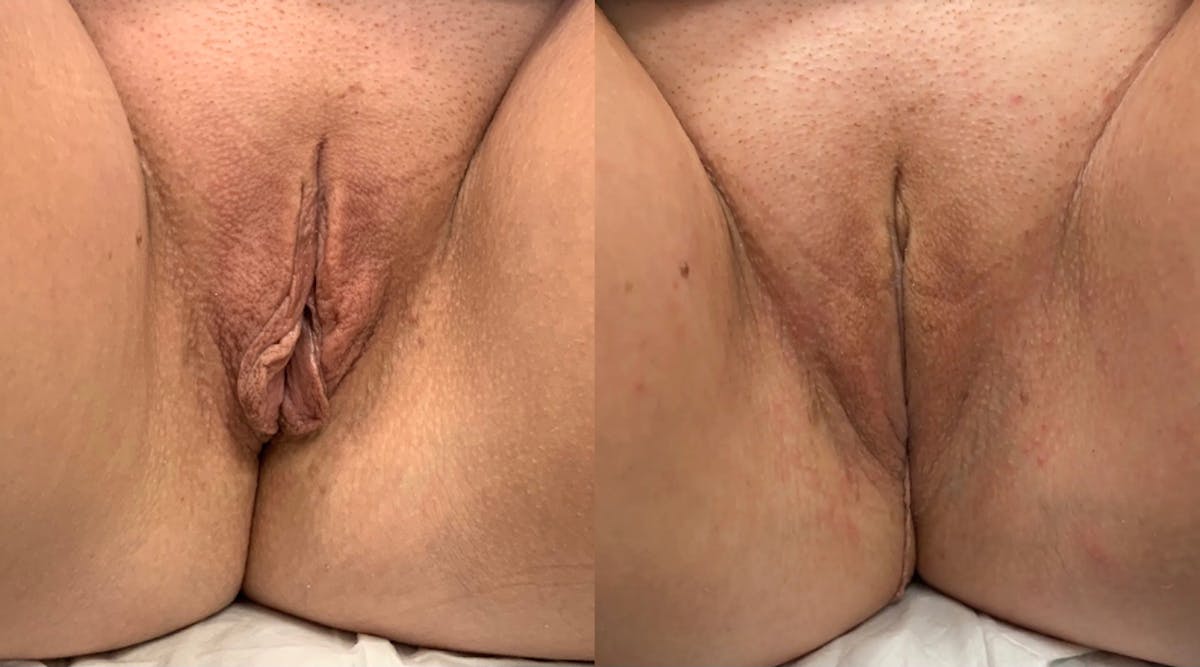 Labiaplasty Before & After Gallery - Patient 108592 - Image 1