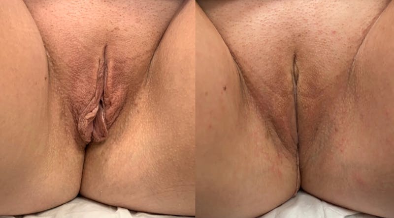 Labiaplasty Before & After Gallery - Patient 108592 - Image 1