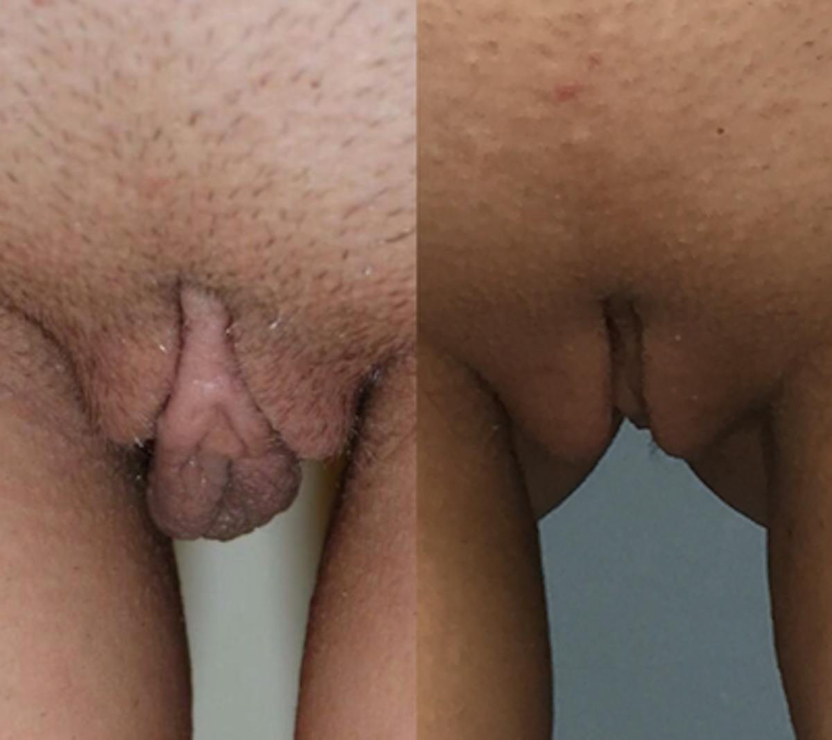 Labiaplasty Before & After Gallery - Patient 255943 - Image 1