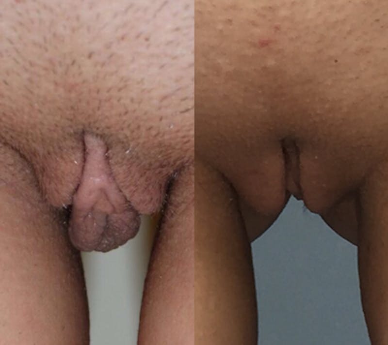Labiaplasty Before & After Gallery - Patient 255943 - Image 1