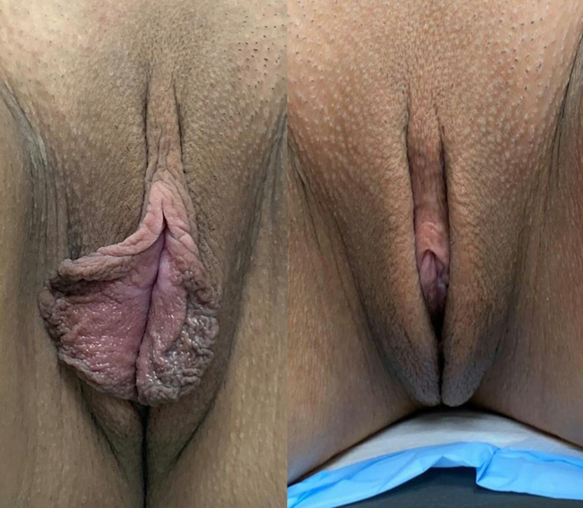 Labiaplasty Before & After Gallery - Patient 305341 - Image 1