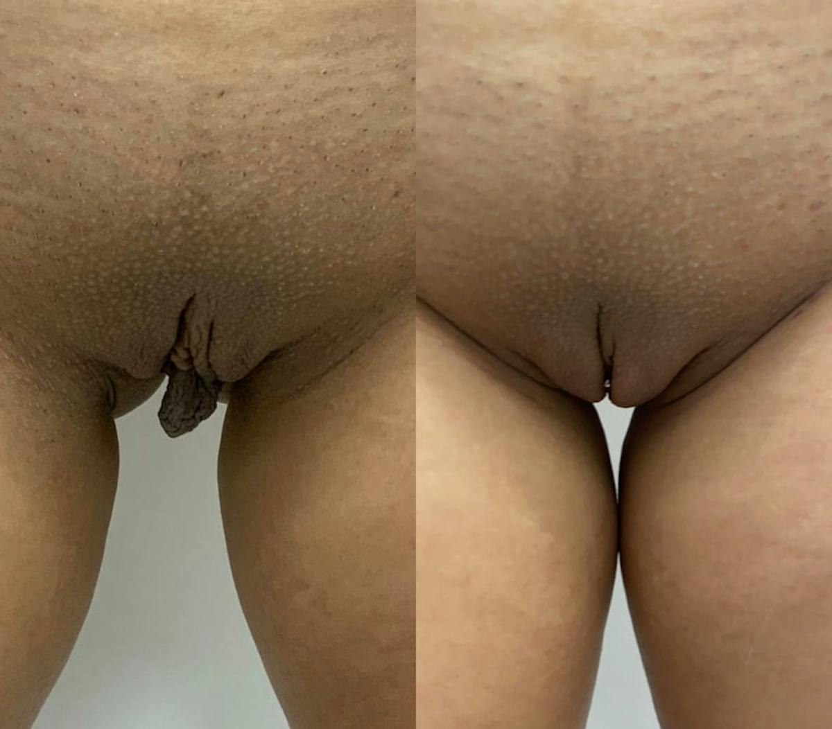 Labiaplasty Before & After Gallery - Patient 235798 - Image 1