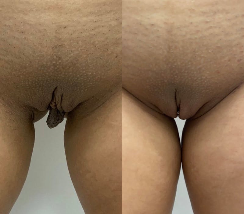Labiaplasty Before & After Gallery - Patient 235798 - Image 1