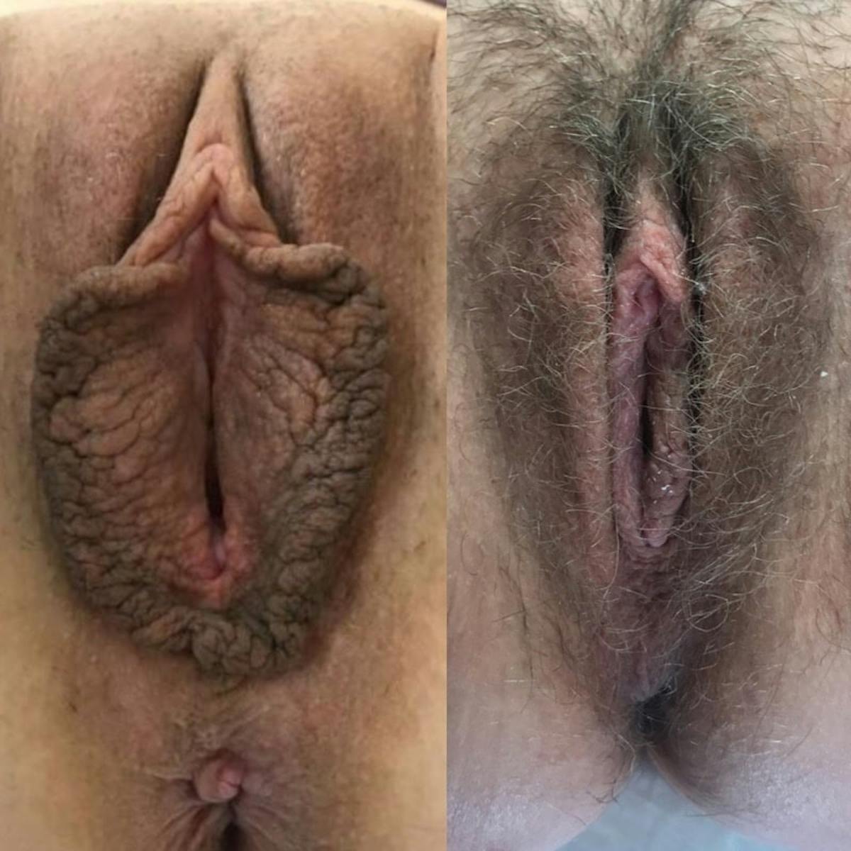 Labiaplasty Before & After Gallery - Patient 220854 - Image 1