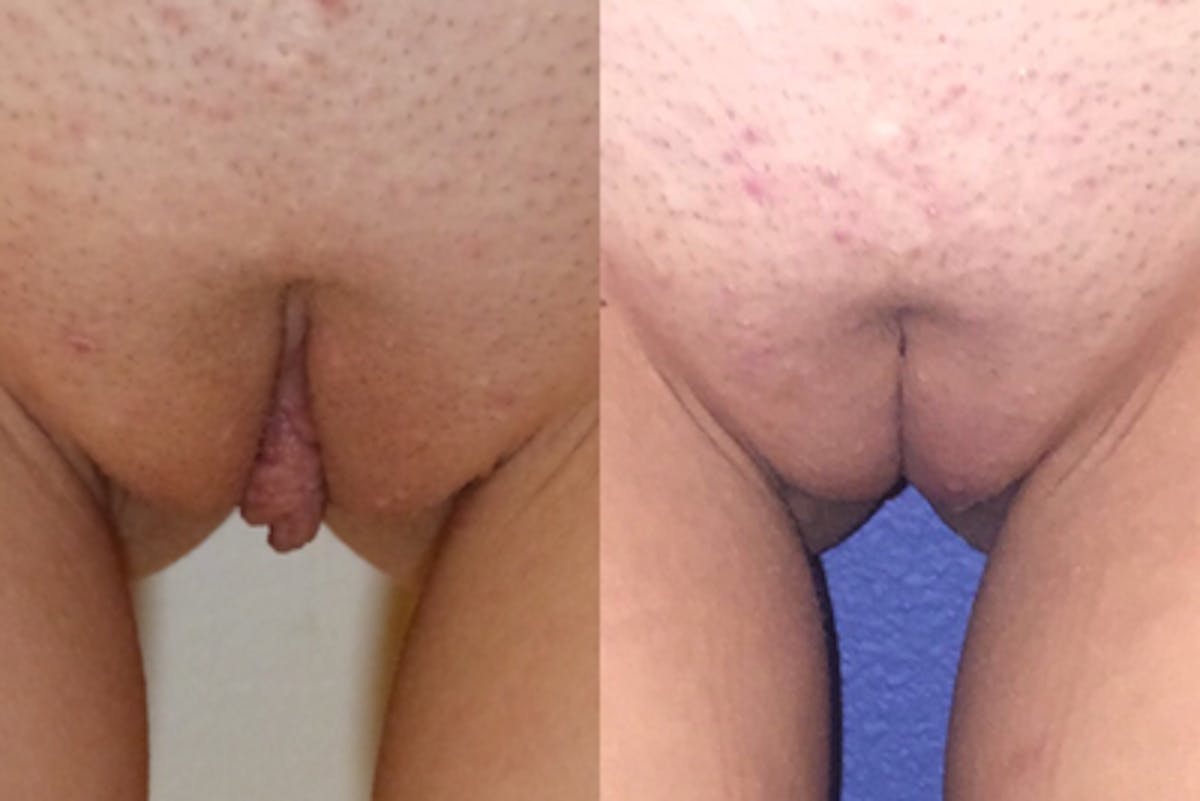 Labiaplasty Before & After Gallery - Patient 256760 - Image 1