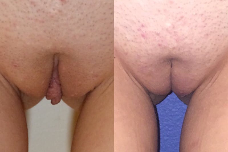 Labiaplasty Before & After Gallery - Patient 256760 - Image 1